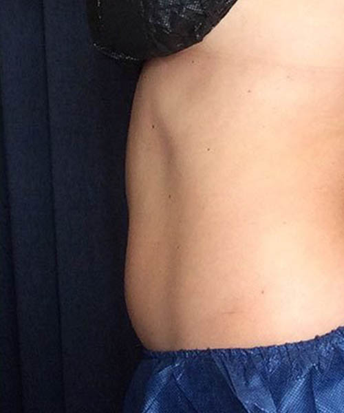 After Fat Freezing Before After