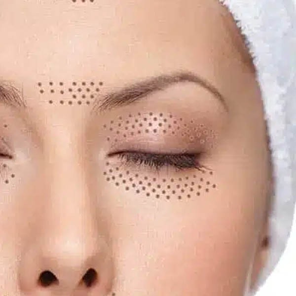 Plasma Eye Lift